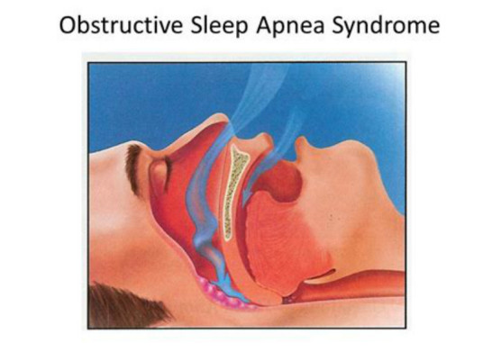 老年人睡眠呼吸暂停综合征