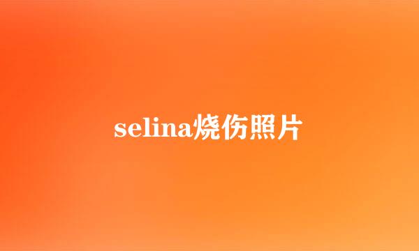 selina烧伤照片