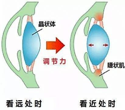 怎样治疗近视