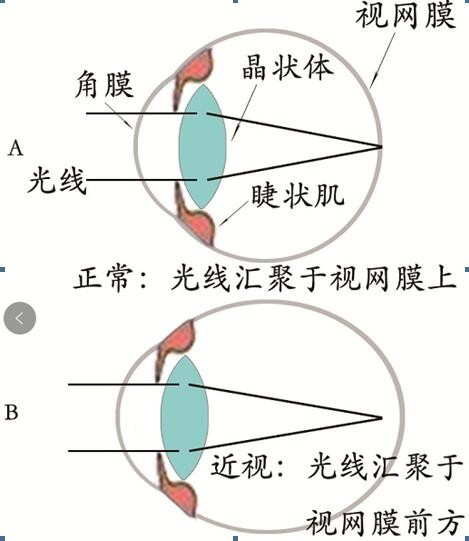 怎样治疗近视