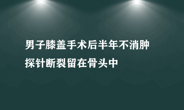 男子膝盖手术后半年不消肿 探针断裂留在骨头中